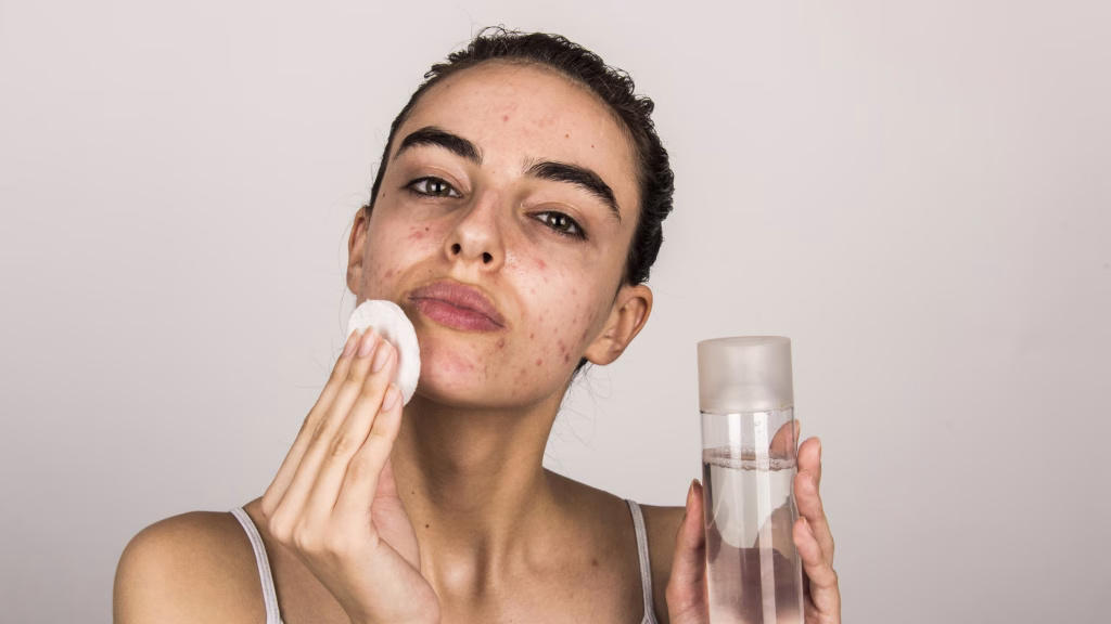 10 Langkah Membentuk Rutinitas Skincare untuk Kulit Berjerawat